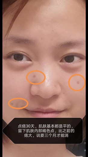 【激光点痣后期恢复情况】点痣后，会不会留疤呢？是坑还是疤？面部三颗小痣，后期恢复情况一个月追踪