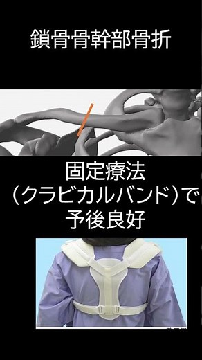 今さら聞けない１分でわかる鎖骨骨折について #雑学 #anatomy #リハビリ #筋肉 #解説 #雑学 #リハビリテーション