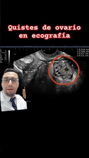 Quistes de ovario en ecografía #doctor #ecografia #embarazo #cabeza #quistes#de #ovariopoliquistico