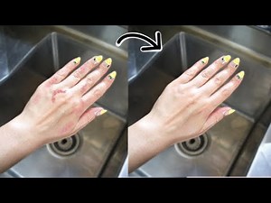 How to get rid of Ringworm from your hands!
