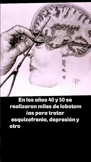 🧠 Cuando “curaban” la mente cortando el cerebro