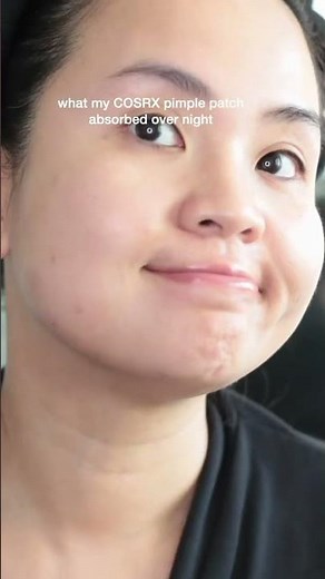 Do Pimple Patches Actually Work?