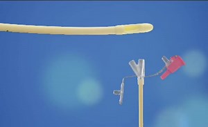 Nasogastric Intubation