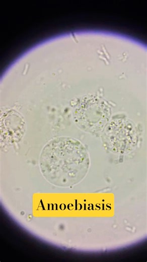 Entamoeba histolytica cysts under Stool Microscopy