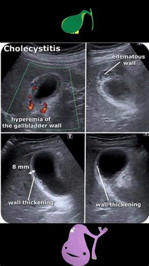 Acute Cholecystitis #viralvideo #ultrasound #cholecystitis #facts #education #abdominalultrasound