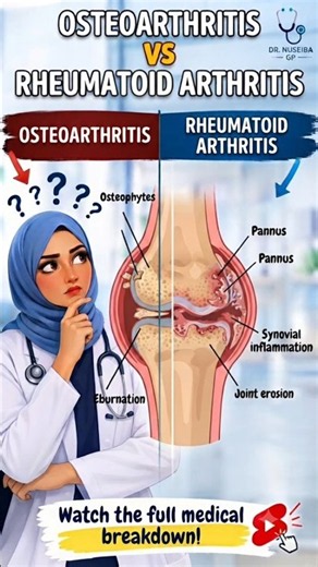 Osteoarthritis vs Rheumatoid Arthritis: Joint Comparison! 🩺📊 #Shorts