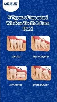 Impacted Wisdom Teeth: Surgical Techniques & Burs You Must Know
