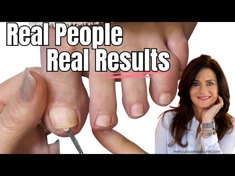 Rheumatoid Arthritis and Foot Care Pedicure Tutorial