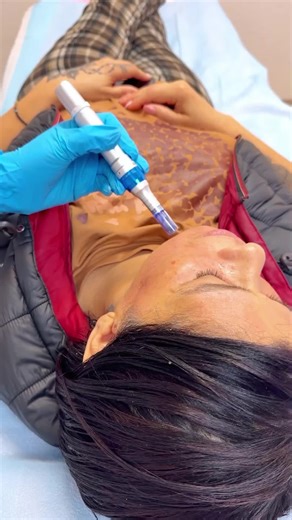Your skin has an incredible ability to renew itself, and Microneedling knows how to activate it. Each tiny micro-needling session stimulates collagen and elastin, helping to smooth fine lines, improve texture, and reveal a natural, radiant glow that everyone notices. Feel the transformation your skin will remember: firmer, luminous, and beautifully even. Book your appointment at Belleza Med Spa and Clinic—we’re specialists in aesthetic medicine.