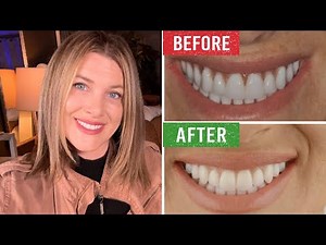 Must Watch! How My Phonares Hybrid Dentures were Designed