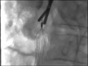 IVC Filter removal using forceps technique