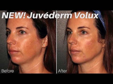 Juvederm Volux Jawline and Chin Definition by Dr. Frame and Dr. Lo - Expert Talk