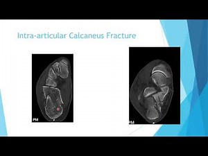 Calcaneus Fracture