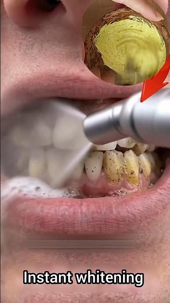 How to whiten your teeth and remove tartar in seconds