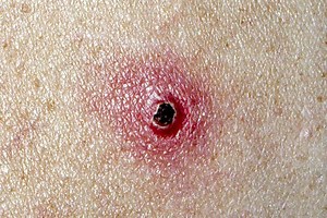 Cat Scratch Fever Symptoms and Treatment | LoveToKnow Pets