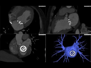 4D viewer for Aortic & Mitral valve TAVI protocol