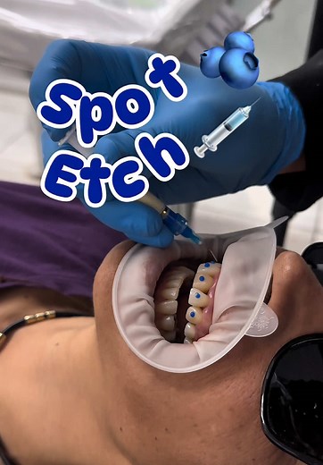 Técnica Spot Edge para Dientes Provisionales