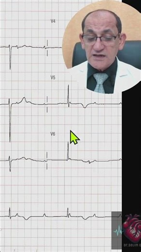 AV BLOCK ECG CRITERIA 6