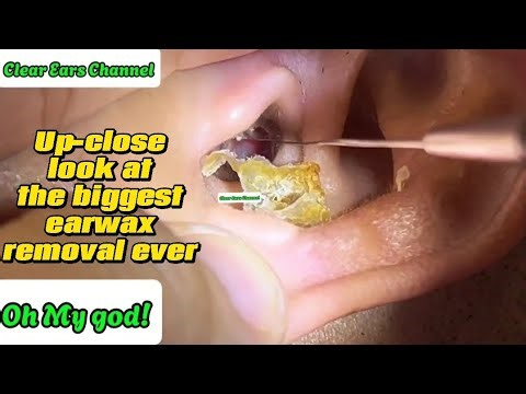 Up-close look at the biggest earwax removal ever | Ear Wax Removal Pro