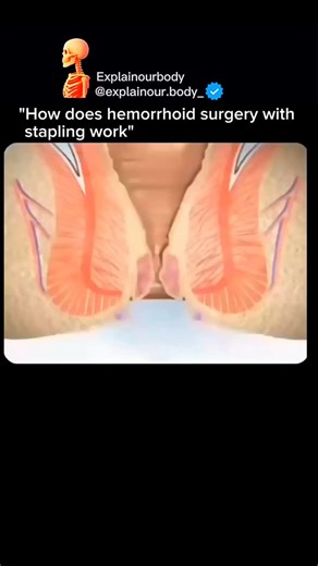 Explainourbody on Instagram: "Hemorrhoid stapling surgery doesn’t remove hemorrhoids — it repositions them. A circular stapler is used inside the rectum to cut a ring of tissue and place tiny staples. This reduces blood flow and pulls swollen tissue back into place. The result? Less pain, quicker recovery, and shrinking hemorrhoids over time. This method is usually used for internal hemorrhoids and is decided by a specialist. Surgery is not the first option — lifestyle changes and medicines are 