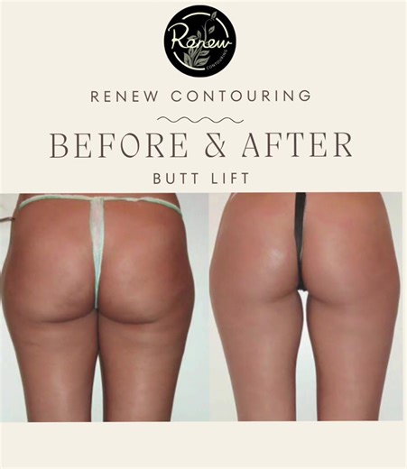 Catch this deal before it’s gone! Spring Break is in 6-7 weeks! 5 treatments on any area of your choice for $600! 🍑 Butt Lift 🍒 Breast Lift 🧖‍♀️ Face Lift 🤍 Neck Lift 💪 Buff Arms ❤️ Tone Tummy 🩶 Slim Thighs 💗 Bye Bye Bra Rolls Treatments for men… 💪 Buff Arms 🤩 Six Pack Tone Tummy 😍 Muscular Thighs 😎 Face Lift 🤯 No More Big Back Call/text or book online: ☎️ 334-219-0075 🌐 RenewContouring.com 📍 Auburn & Columbus #noninvasivebodycontouring #fyp #laserlipo #fatcavitation #rfskintigheni