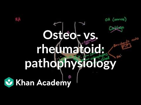 Osteoarthritis vs rheumatoid arthritis pathophysiology | NCLEX-RN | Khan Academy