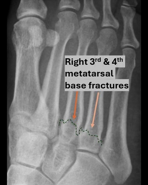 Metatarsal base fractures