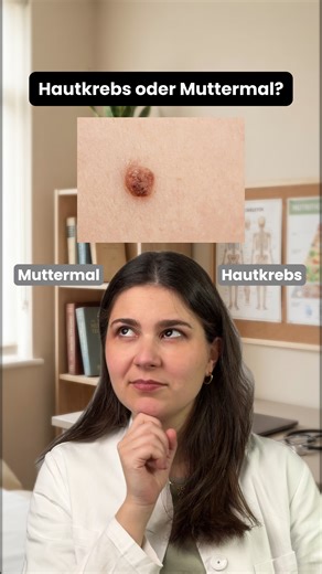 So unterscheidest du ein Muttermal von Hautkrebs ⤵️ Ich bekomme regelmäßig Nachrichten wie: „Alice… ist das Hautkrebs?“ Hi, ich bin Alice – Ärztin und Gründerin der digitalen Hautarztpraxis @dermanostic und teile hier regelmäßig Tipps rund um Haut und Haare Deshalb einmal der wichtigste Unterschied: Wann ist ein Muttermal harmlos – und wann sollte man genauer hinschauen? Dafür gibt es eine einfache Regel aus der Dermatologie: die ABCDE-Regel. 1️⃣ A – Asymmetrie Normale Muttermale sind meist rund