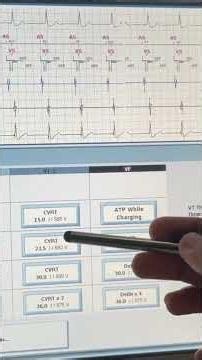 ICD Therapy Zones Explained #cardiacdevices #defibrillator #heartmeetsmachine #icd