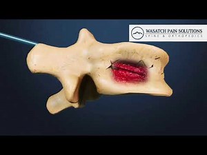 Kyphoplasty Osteoporosis Fracture Treatment Video