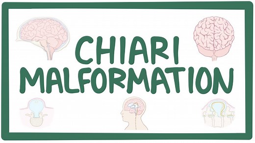 Chiari malformation: Video, Causes, & Meaning | Osmosis