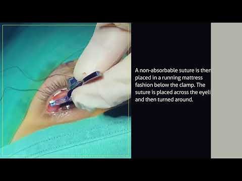 Droopy eyelid surgery without a scar: safe, quick, and effective