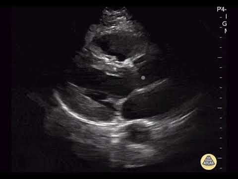 Normal Parasternal Long Axis View