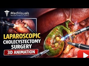 Laproscopic cholecystectomy surgery#medical #3danimation#surgery#medvisuals#viral‪@MedVisuals-123‬