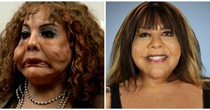 See the Most Extreme Plastic Surgery Transformations on Botched!