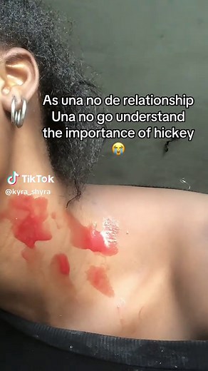 Understanding the Meaning and Importance of Hickeys