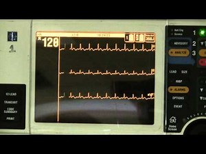 Sinus tachycardia