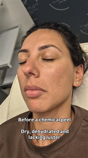 The Academy of Safe Aesthetics | Chemical peels remain one of the most underutilised yet clinically effective treatments in aesthetic practice. Training in chemical peels... | Instagram
