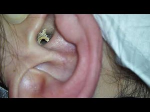 Most satisfying ear wax removal with microscope