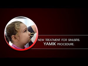 New Treatment for sinusitis. Yamik procedure - topical treatment of sinusitis.