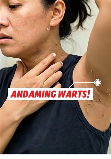 Nag try ka na ba tanggalin ang warts mo pero mahapdi at nagsusugat? 😨😨 #ultimawartsoap #wartsoap