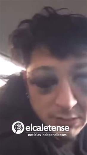 Músico de Pico Truncado denuncia agresión policial y teme perder un ojo. Ariel Carrizo, músico de Pico Truncado, denunció haber sido víctima de violencia policial durante un control de alcoholemia. Con graves lesiones en el rostro y riesgo de perder la visión en uno de sus ojos, exige justicia e identificación de los responsables. Según relató en un video en sus redes sociales, tras intentar evitar un control vehicular fue interceptado y agredido: “Recuerdo que me bajaron del auto, sentí un golp