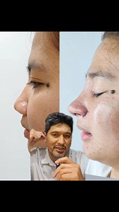 Arci Muñoz nose | Clara V Clinic