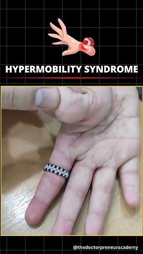 Hypermobile Joint Syndrome (Ehlers-Danlos Syndrome - EDS) 🦴✨