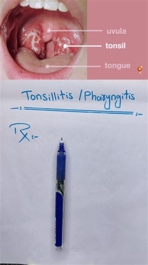 Understanding Tonsillitis and Pharyngitis Symptoms