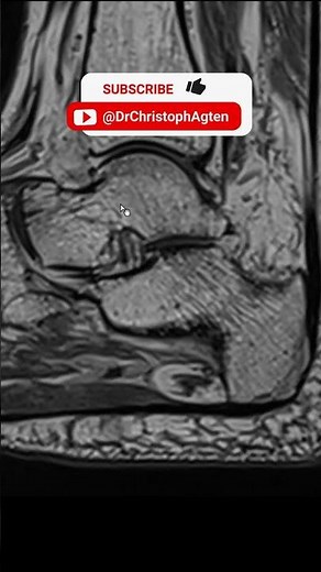 ESSR 2023 Bilbao Highlight 2 - Anterior Capsular Ligament