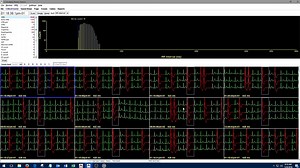 HE/LX Holter Analysis Chapter 1.Introduction to Holter Analysis