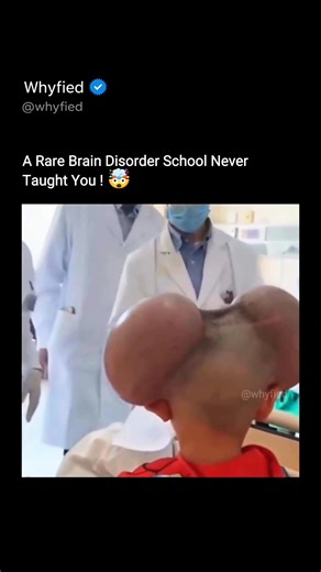 Whyfied on Instagram: "🧠 Hydrocephalus: When the Brain Faces Dangerous Pressure Hydrocephalus is a serious medical condition where excess cerebrospinal fluid (CSF) builds up inside the brain. This fluid normally protects the brain, but when it can’t drain properly, it creates pressure that causes the brain to swell—sometimes dramatically. This condition can affect newborns, children, and even adults. As pressure increases, it can damage brain tissues, leading to symptoms like head enlargement (