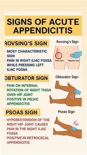 Kapildeep Kaur on Instagram: "High-yield APPENDICITIS signs you MUST know! Rovsing’s • Obturator • Psoas These 3 signs appear again & again in nursing exams. Save this for your last-minute revision 🔥 💙 #nursingstudents #nclexprep #nursingnotes #appendicitis #medicallearning #kapsnursingclasses #nclex #nclexrn #norcet"