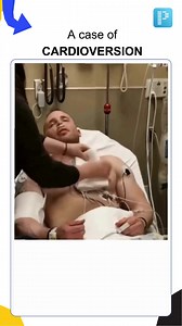 📢 READ CAPTION ⚠️ Cardioversion is a medical procedure used to restore a normal heart rhythm in individuals with certain types of abnormal heart rhythms, particularly atrial fibrillation or atrial flutter. It involves delivering a controlled electric shock to the heart, either externally through the chest wall or internally via catheters placed within the heart. There are two main types of CARDIOVERSION: 🔷Synchronized Cardioversion: This form is used for irregular rhythms like atrial fibrillat